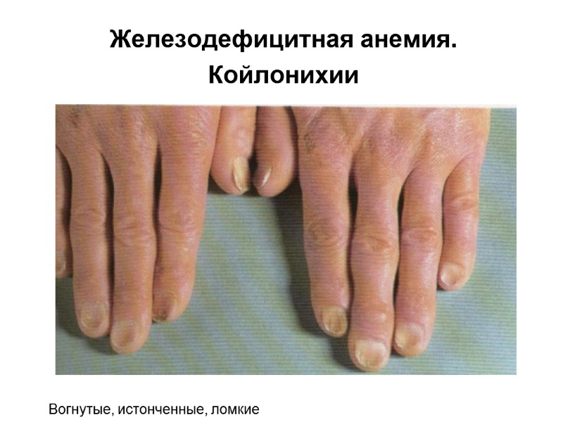 Железодефицитная анемия. Койлонихии Вогнутые, истонченные, ломкие